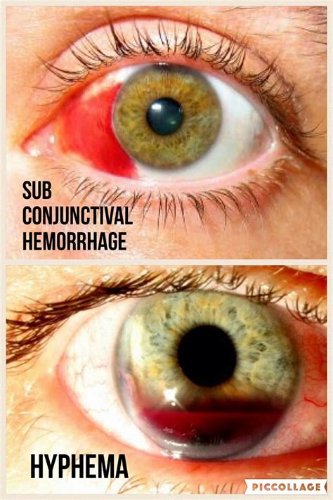 Subconjunctival Hemorrhage V Hyphema Naturalhomeremediesforcold In