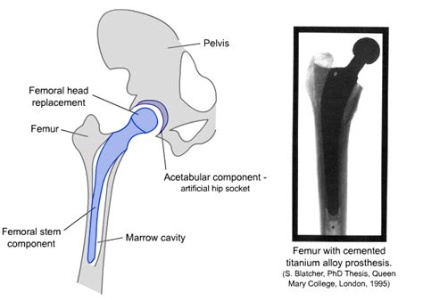 Your leg bones are the longest and strongest bones in your body. DoITPoMS - TLP Library Structure of bone and implant ...