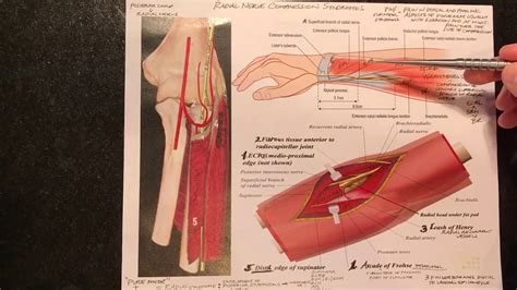 Radial Nerve Compression Syndromes Radial Tunnel Syndrome Wartenberg