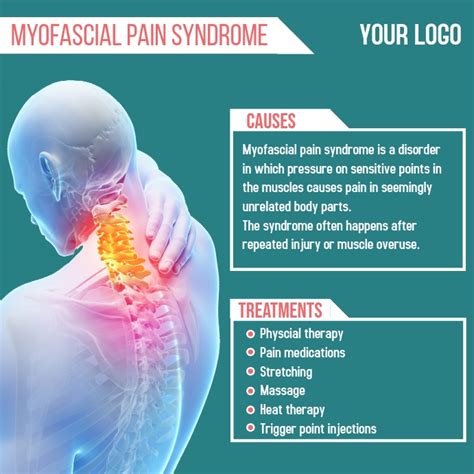 Copy Of Myofascial Pain Syndrome Postermywall