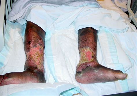 Clinical Cases And Images Diabetic Foot Infection Of Stasis Ulcers