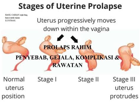 prolaps RAHIM jatuh 子宫下垂 uterus Prolapse LAINindividuLAINkesan habiskan dlm mingguUBAT