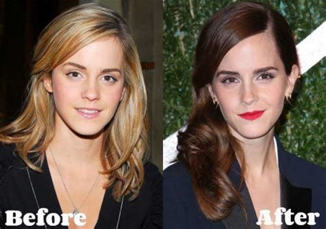 Emma Watson Plastic Surgery Boob Job Nose Job Eyelid Surgery