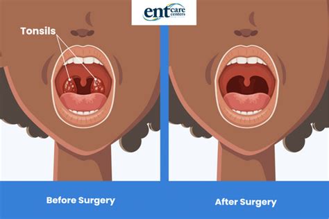 Tonsils Before And After