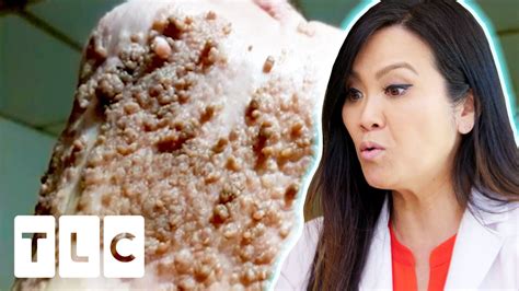 I Ve Never Seen Quite An Extensive Case As This Dr Pimple Popper Before The Pop Youtube