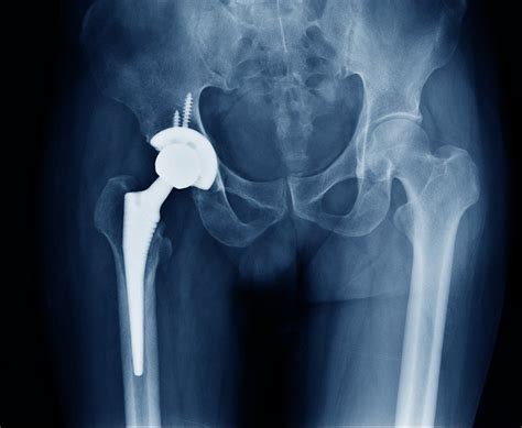 Hip Replacement Know Everything About It Ayushman Hospital And Health Services