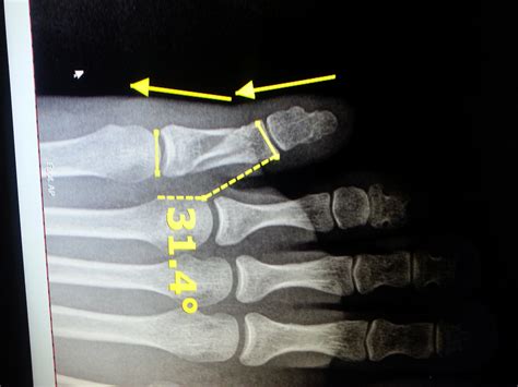 Toe Fracture Foot Doctor San Diego La Jolla Podiatrist