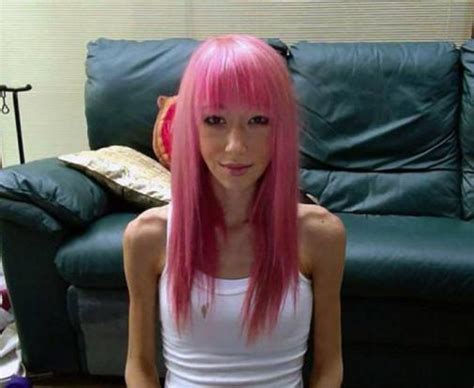 30kg Anorexic Woman Turns Her Life Around And Youll Marvel At How She Looks Like Now Stomp
