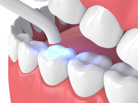 Restore Your Teeth With Composite Fillings At Somerset Smiles