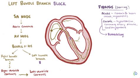 Left Bundle Branch Block Lbbb Bundle Branch Block Acls Ekg