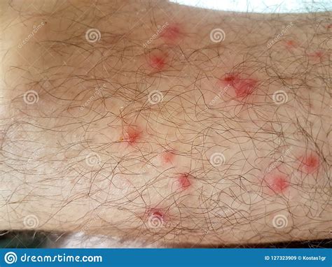 Pimples Flea Insect Man Feet Stock Image Image Of Allergy Irritated