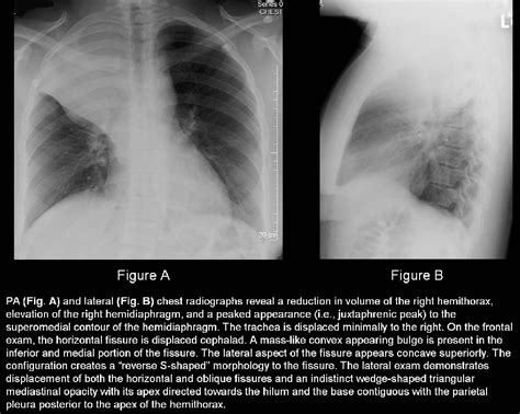 Complicated Right Upper Lobe Atelectasis Caused By A Large Hilar Mass
