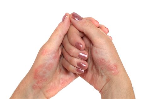 Transition From Onset Of Psoriasis To Psoriatic Arthritis Linked To