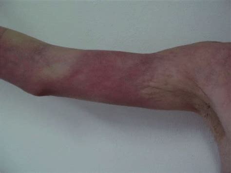 Eosinophilic Fasciitis With Initial Clinical Manifestation Of
