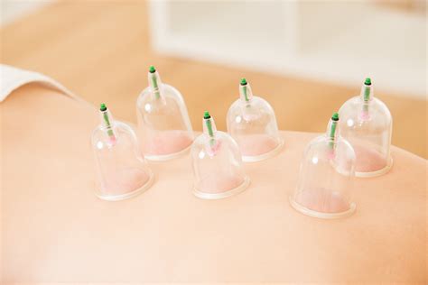 Different Methods Of Cupping Therapy Discoverhealth