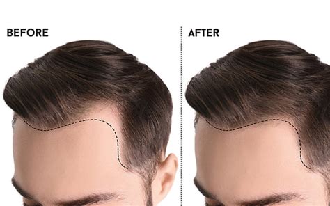 Understanding The Different Types Of Hairlines For Men And Women Skinkraft