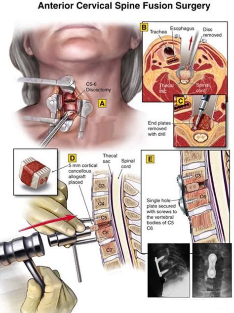8 Best Cervical Disc And Fusion Surgery Images Cervical Disc Surgery Acdf Surgery