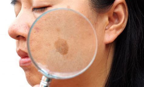Everything You Should Know About Melasma Norman J Pastorek Md Pc