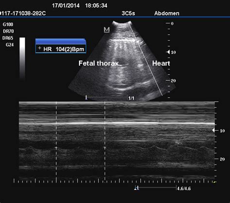 Measurement Of Fetal Heart Rate Fhr By M Mode Ultrasonography Imaged