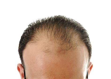 Hair Loss Male Patterned Baldness And The Copb2 Gene Selfhack