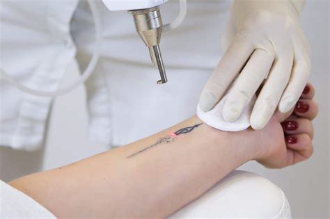 Tattoo Entfernen Die Besten Methoden Und Zahlreiche Pflegetipps