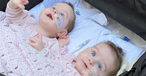 Ni Parents Share First Photo Of Formerly Conjoined Twins After