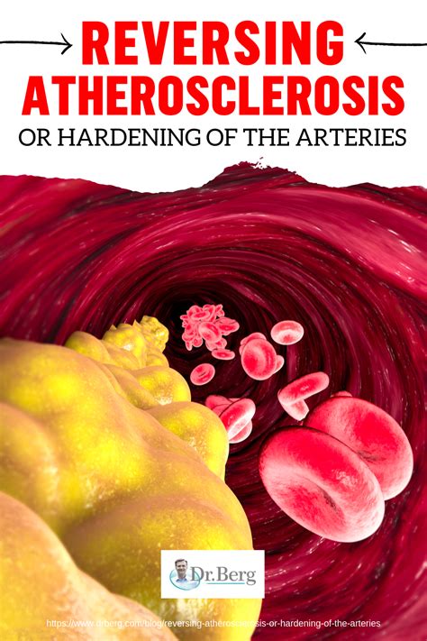Reversing Atherosclerosis Or Hardening Of The Arteries Arteries Good