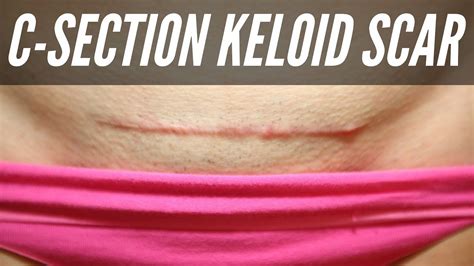 C Section Scar Keloid DOES C SECTION SCAR MASSAGE CAUSE KELOID YouTube