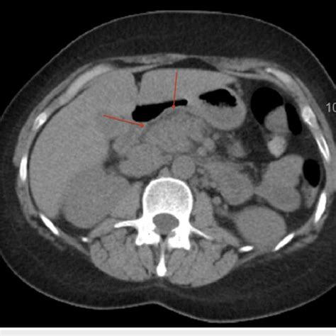 Upper Abdominal Ct Scan Without Contrast Shows Peripancreatic Edema
