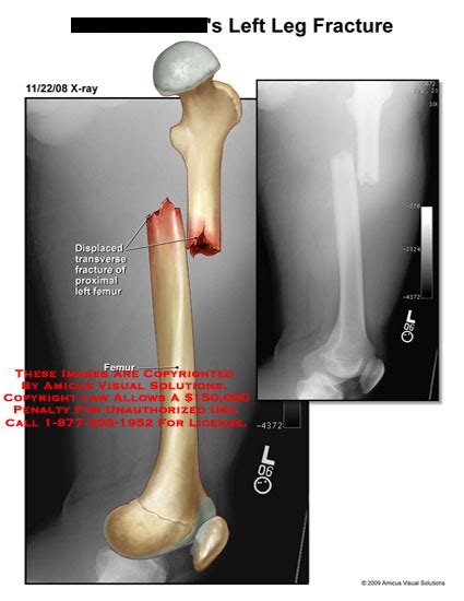 Amicus Illustration Of Amicus Injury Leg Fracture X Ray Displaced