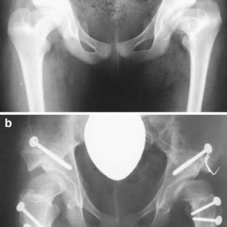 A Postreduction Avascular Necrosis Of Both Hips In A 12 Year Old