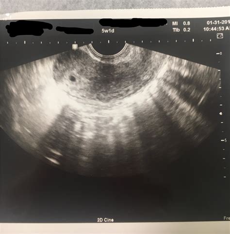 Post Ultrasound Photos Here — The Bump