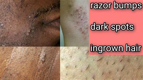 How To Get Rid Of Razor Bumps Dark Spots And Ingrown Hair Youtube