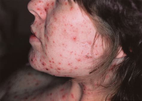 The rash has been present for 3 days. Herpes Zoster (Shingles) | Diseases & Conditions ...