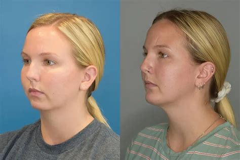 Chin Implants Beverly Hills 4000