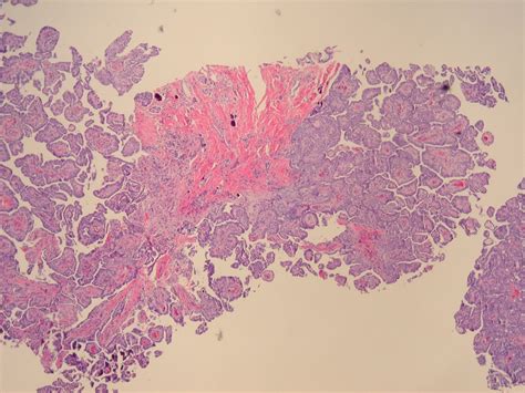 Benign Mesothelioma Pathology Outlines A Collection