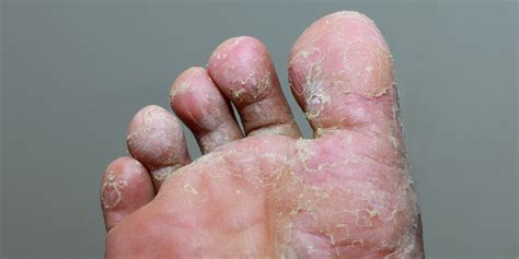 What Causes Fungal Infection On The Skin