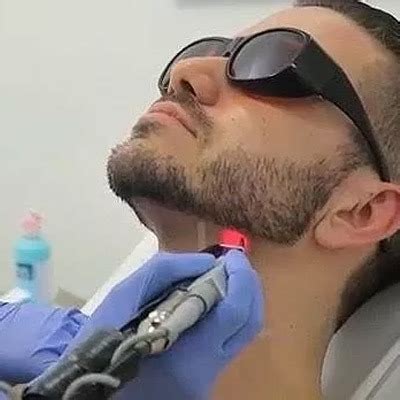 This is an ancient hair removal method that works! Beard Laser Hair Removal in Dubai | Skin Care Clinic UAE