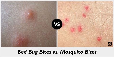 Bed Bug Bites Vs Mosquito Bite Larablog