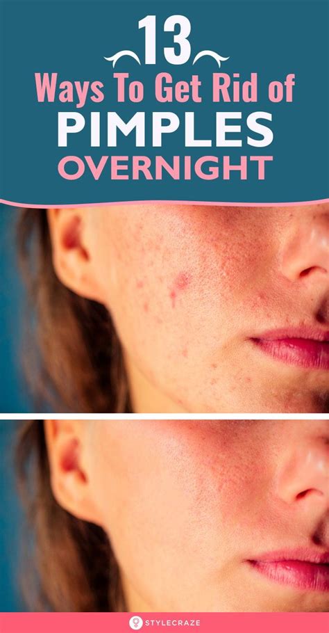 How To Get Rid Of Pimples Overnight Fast How To Get Rid Of Pimples