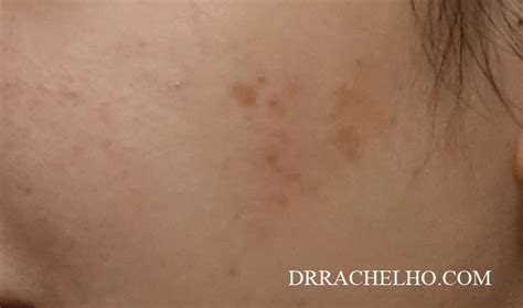 Dr Rachel Ho Hyperpigmentation Disorders Causes Types Treatments