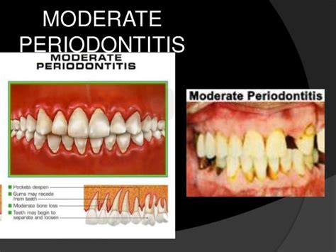 Chronic Periodontitis