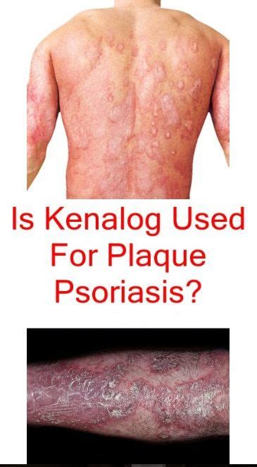 Psoriasis Causes Symptoms And The Vitamin Youre Missing Psoriasis