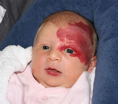 We did not find results for: Hemangioma, Birth Mark, Red Mark on Face
