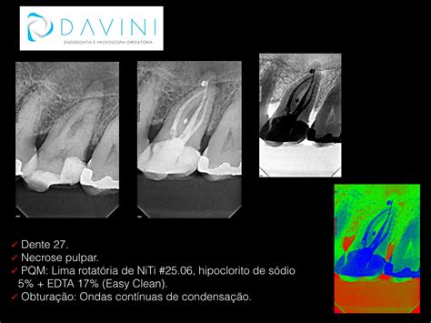 Dentes Artificiais Para Endodontia