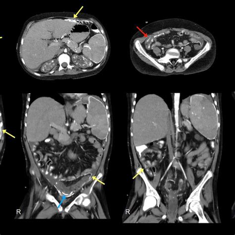Abdominal Radiographs Demonstrate A Nonobstructive Bowel Gas Pattern