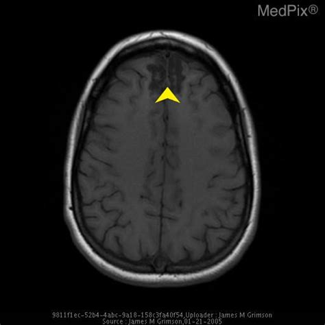 Traumatic Brain Injury Mri Wikidoc
