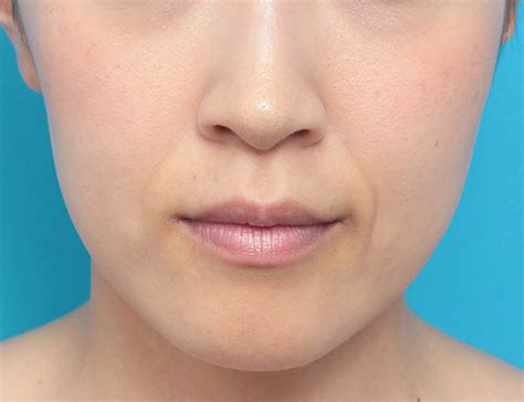 20代女性の法令線の折れジワにヒアルロン酸注射した症例写真：美容外科 高須クリニック