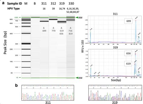 Hpv Dna Detection By Pcr Amplification Capillary Electrophoresis And