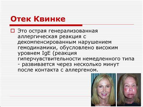 Отек лечение диета Аллергический цистит: симптомы, лечение, как распознать Аллергический цистит: симптомы, лечение, как распознать Отек лечение диета